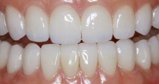 teeth after dental services