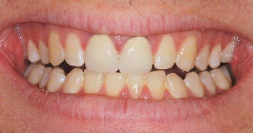Teeth-2-Before